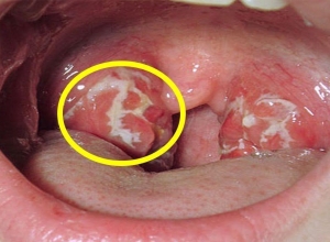 Ung thư vòm họng bắt nguồn từ đâu? Tìm hiểu ngay để biết